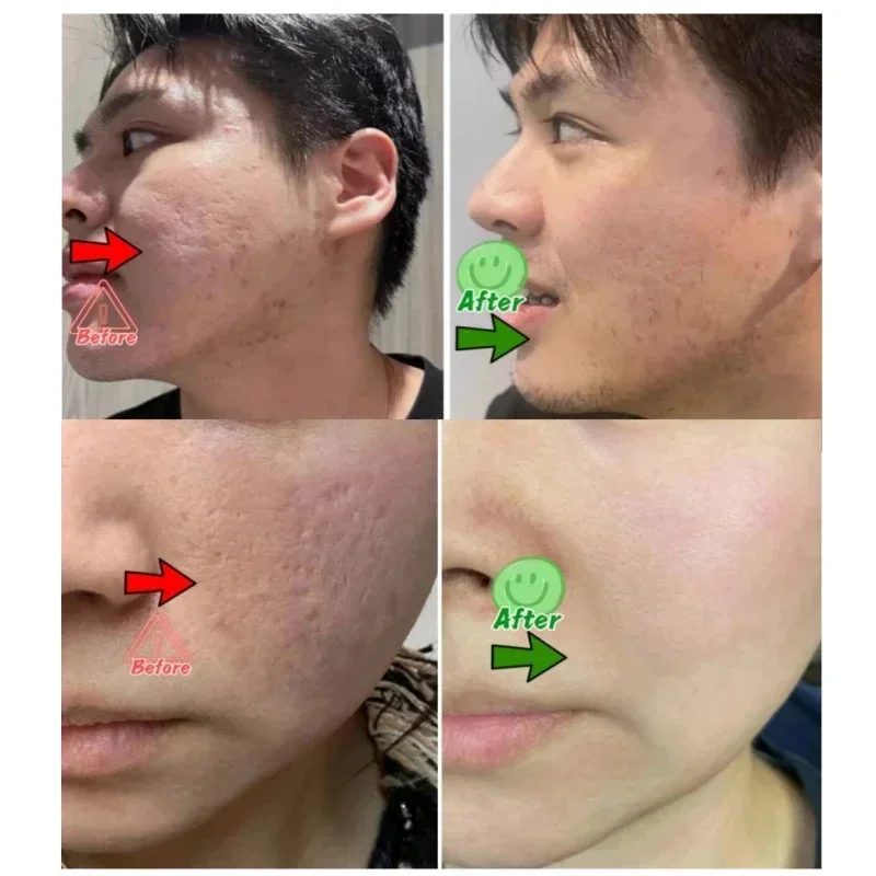 Crème de nettoyage des pores à - Skincare Salicylic Acid avis et prix